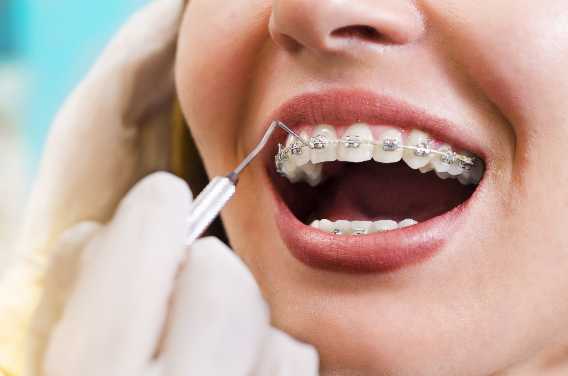 Ortodoncia con brackets metálicos en Santander
