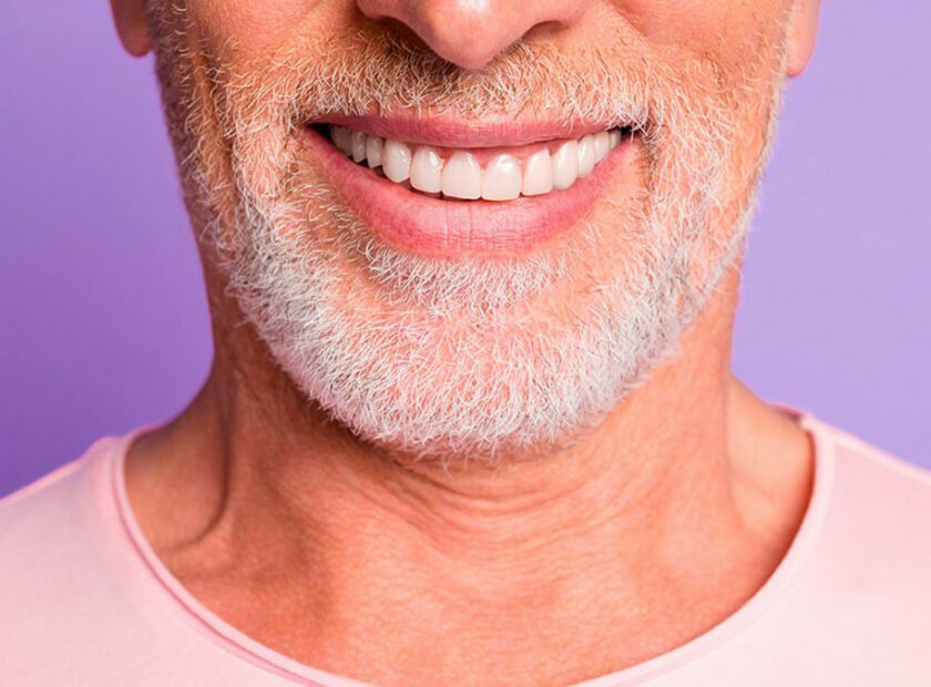 Carillas dentales en Santander, qué son y cuándo se recomiendan