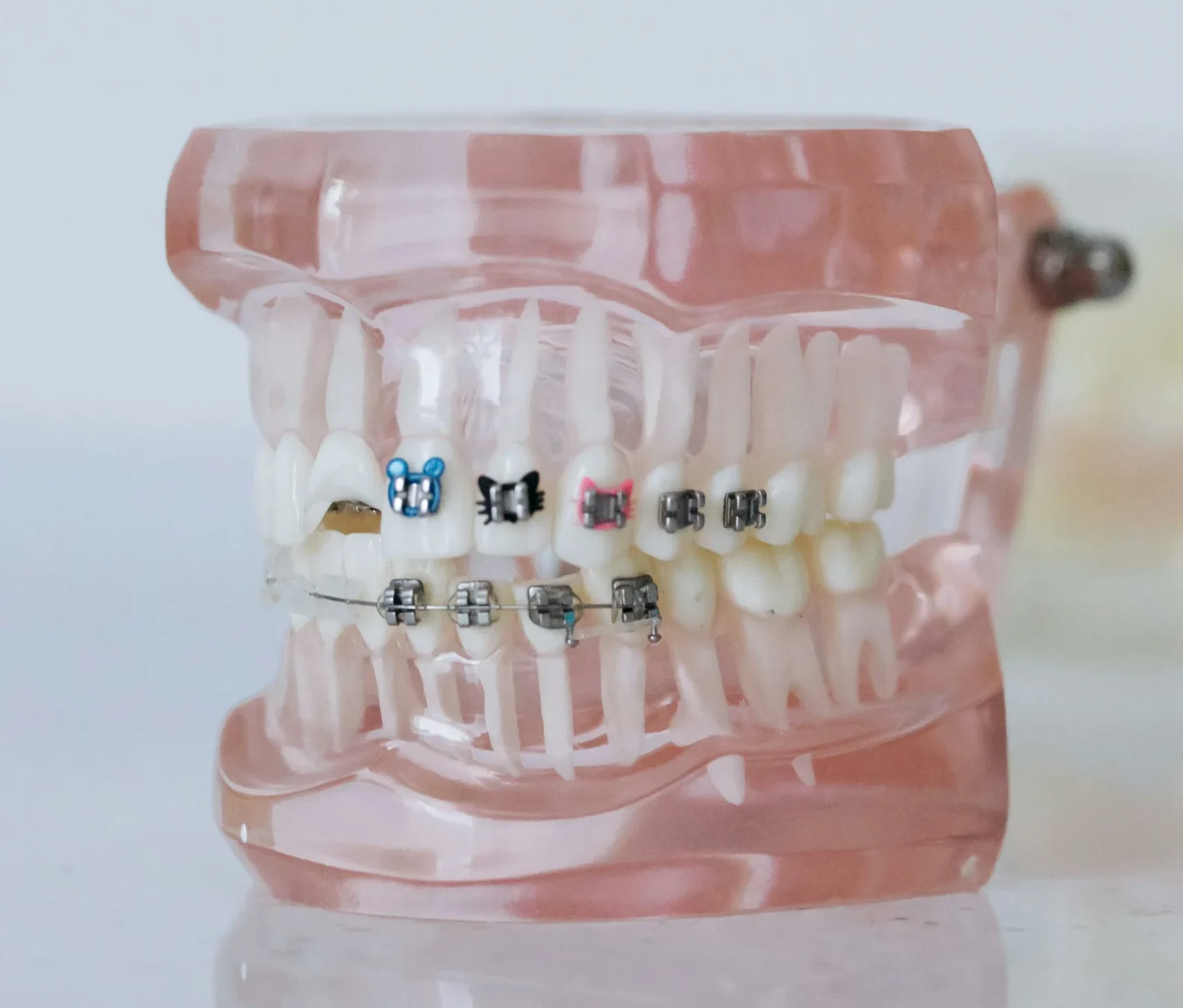 Brackets metálicos en Laredo, tratamiento clásico y eficaz